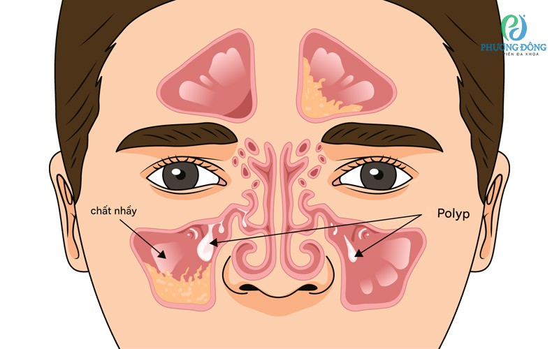 Viêm xoang polyp mũi có thể gây ra nhiều triệu chứng khó chịu và giảm khả năng ngửi