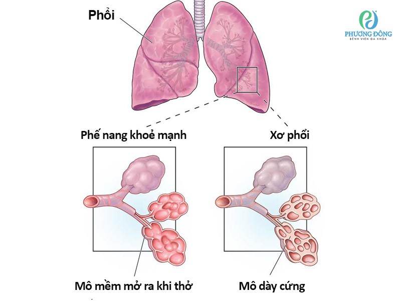 Thời gian sống của người bị bệnh xơ phổi phụ thuộc vào nhiều yếu tố, bao gồm mức độ tiến triển của bệnh, nguyên nhân gây ra xơ phổi, cũng như tình trạng sức khỏe tổng quát của bệnh nhân.