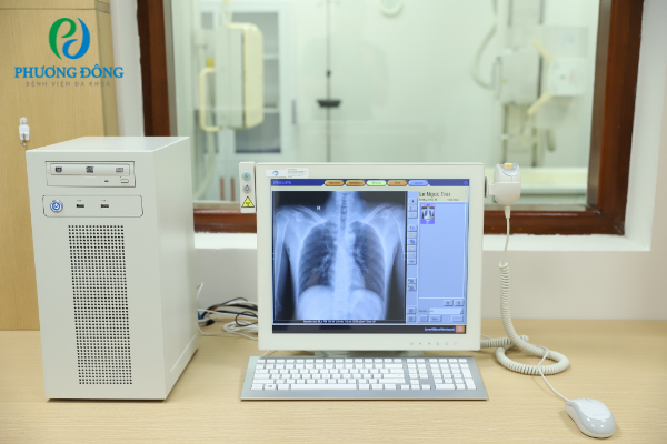 Chụp X-quang ngực thẳng phát hiện sớm những tổn thương bất thường ở phổi