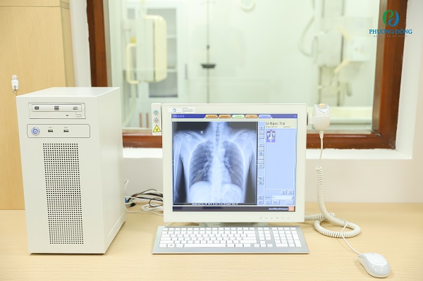 Hình ảnh chụp X-quang ngực thẳng