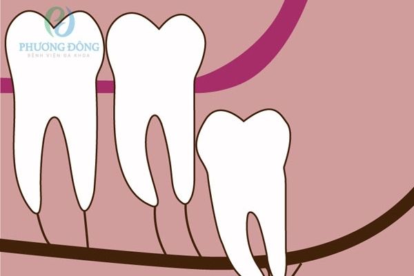 Răng mọc ngầm trong xương hàm thường được phát hiện khi đi chụp x-quang răng