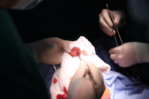 Phẫu thuật cắt Polyp dạ dày