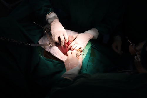 Bác sĩ bóc tách riêng phần khối u để loại bỏ