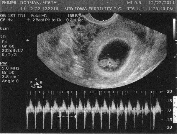Có bao nhiêu loại siêu âm để xác định nhịp tim của thai nhi trong bụng? 
