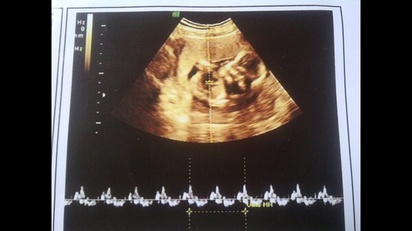 Các biểu hiện nào sẽ cho thấy đây là nhịp tim của thai nhi ở tuần thứ 9?
