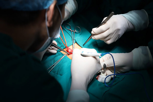 Bác sỹ dùng dao điện để cầm máu, bóc tách các tổ chức, đảm bảo tránh các tai biến không mong muốn trong phẫu thuật nang nước thừng tinh
