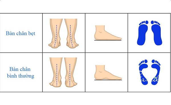 Sự khác biệt giữa bàn chân bẹt và bàn chân bình thường