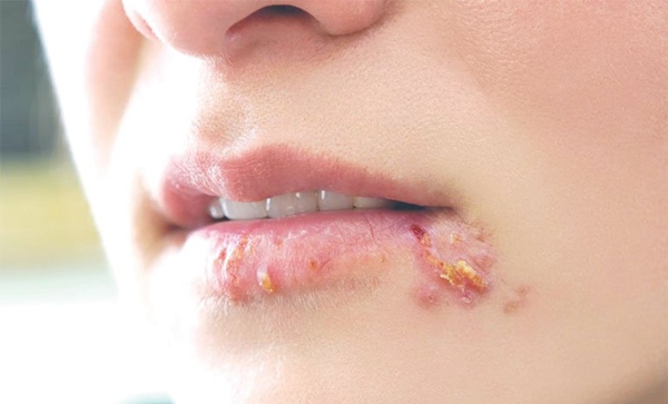 Tìm hiểu triệu chứng bệnh giang mai ở miệng để phòng chống và điều trị kịp thời