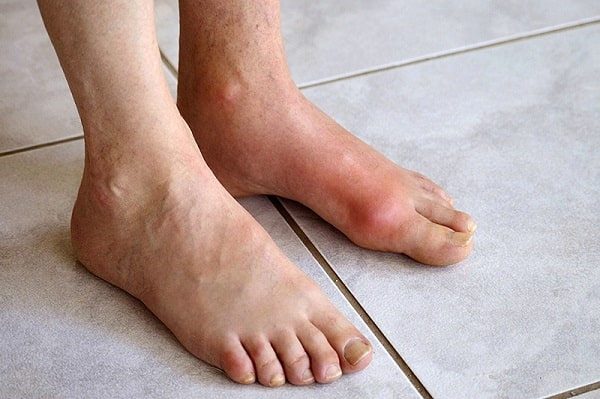 Gout là bệnh lý về xương khớp xuất hiện phổ biển