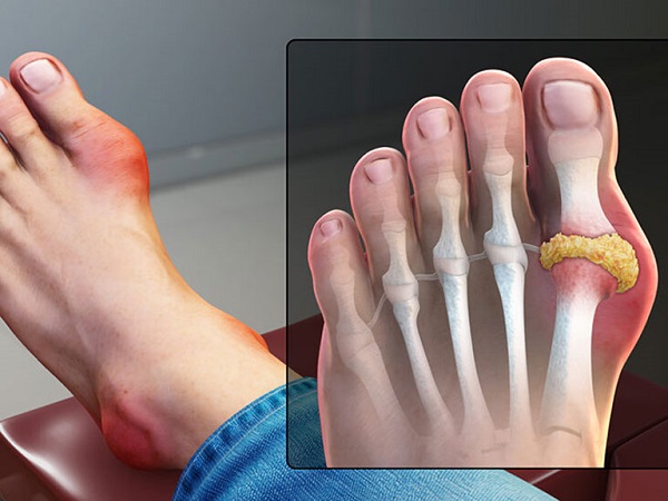 Bệnh Gout(Gút): Nguyên nhân, triệu chứng, chẩn đoán và điều trị