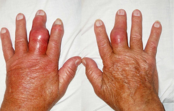 Bệnh gout có thể gây ra nhiều biến chứng nguy hiểm nếu không được chữa trị kịp thời