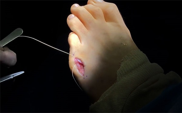 Phẫu thuật cắt bỏ nốt tophi cũng là một phương pháp điều trị gout hiện nay