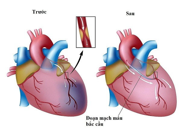 Hình ảnh minh họa kỹ thuật ghép động mạch vành