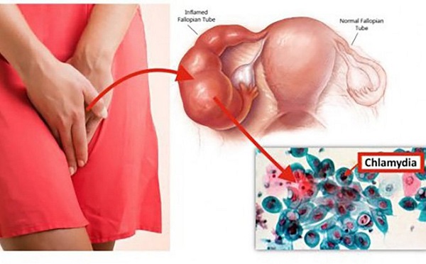 Phụ nữ mắc bệnh Chlamydia sẽ thường xuyên bị chảy máu âm đạo