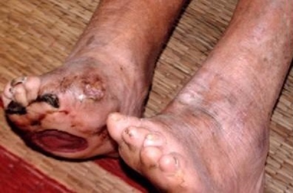 Bàn chân bị loét sâu do bệnh hủi chuyển biến nặng gây nhiễm trùng
