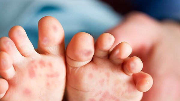 Phát ban dạng các nốt phỏng nước trên da lòng bàn chân là một triệu chứng điển hình của bệnh tay chân miệng