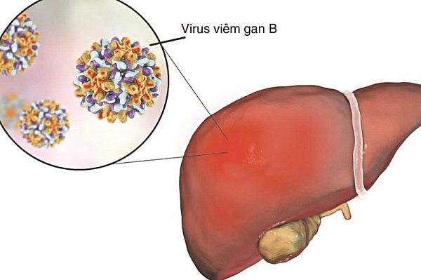 Viêm gan B nằm trong top đầu các bệnh về gan thường gặp