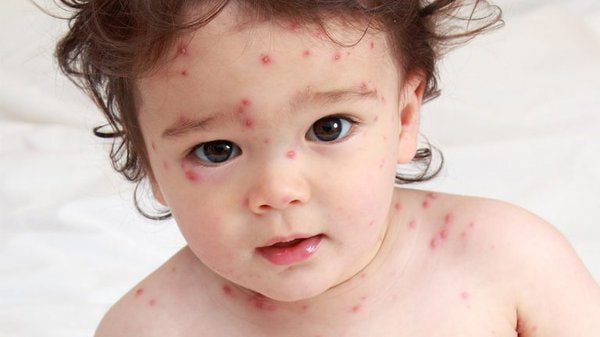 Bệnh thủy đậu ở trẻ em có thể gây biến chứng gì không?