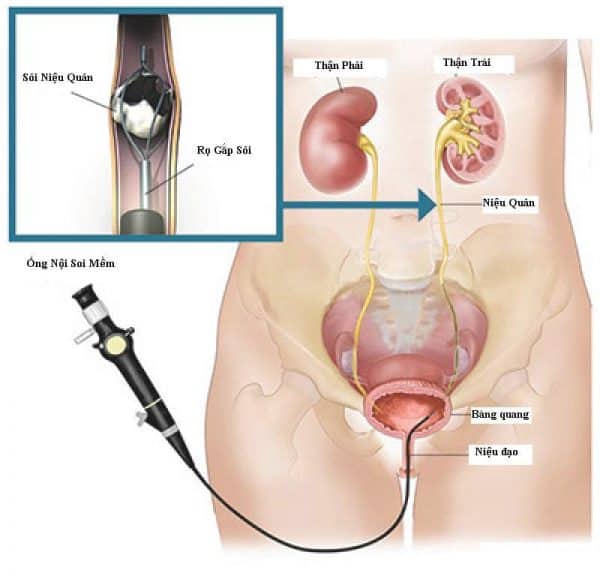 4. So sánh tán sỏi bằng laser và các phương pháp khác