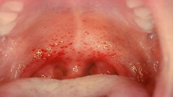 Viêm họng liên cầu khuẩn là biến chứng viêm amidan