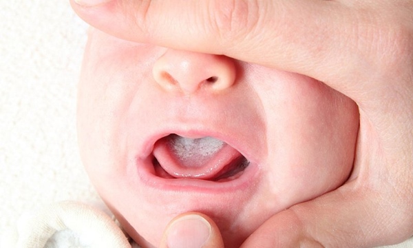 Khi bệnh mới hình thành sẽ xuất hiện nhiều chấm trắng ở đầu lưỡi của trẻ