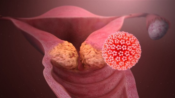 Nguyên nhân chính gây bệnh ung thư cổ tử cung là virus HPV