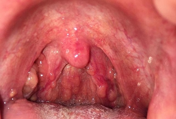 Viêm họng là tình trạng viêm nhiễm niêm mạc họng và hầu, gây đau cổ họng