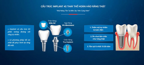 Cấu trúc cấy xương và trồng răng Implant 4S