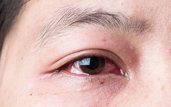 Bệnh đau mắt đỏ có gây ảnh hưởng tới thị lực không?
