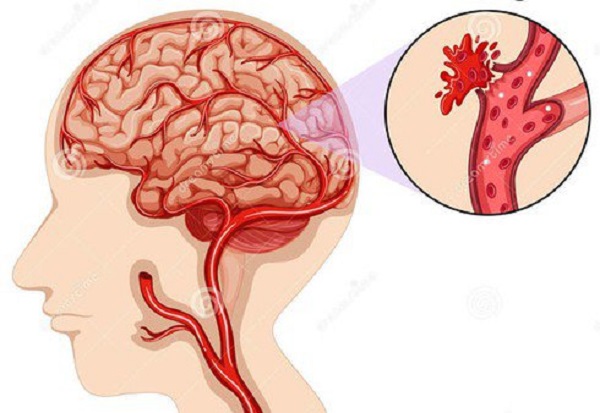 Đột quỵ do xuất huyết não chiếm 15% tổng số ca bệnh