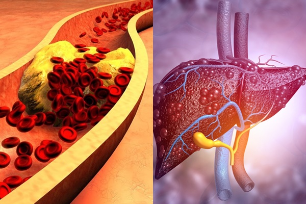 Mỡ máu và mỡ gan có liên quan đến nhau như thế nào?
