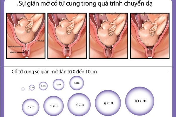 Giai đoạn 1 cổ tử cung sẽ mở ra được 9- 10cm