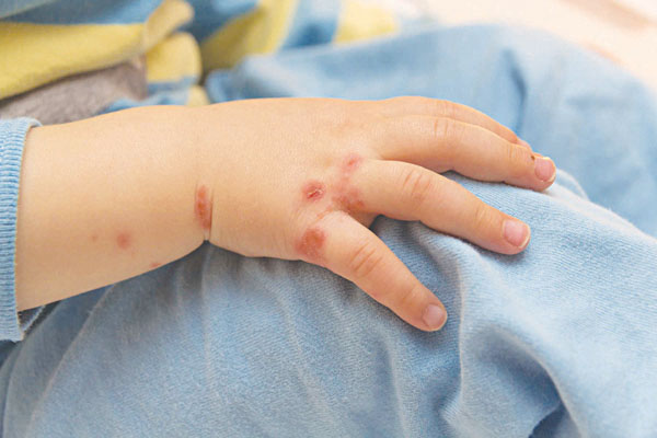 Trẻ xuất hiện các nốt phỏng nước trên da trong giai đoạn toàn phát của bệnh