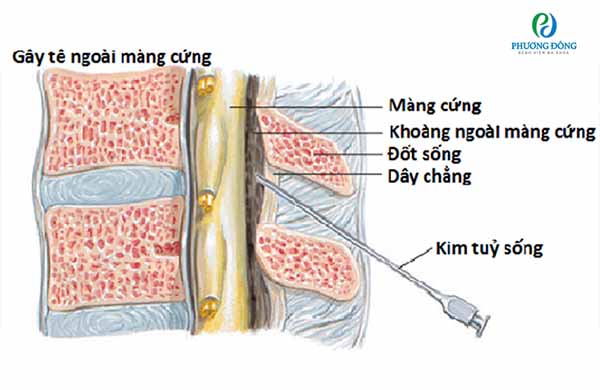 Gói giảm đau sau sinh mổ có tác dụng an thần và giảm đau hiệu quả không?
