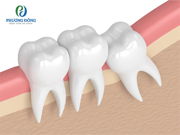 Trước khi nhổ răng khôn người bệnh cần khám dể dưa ra phương pháp điều trị cụ thể