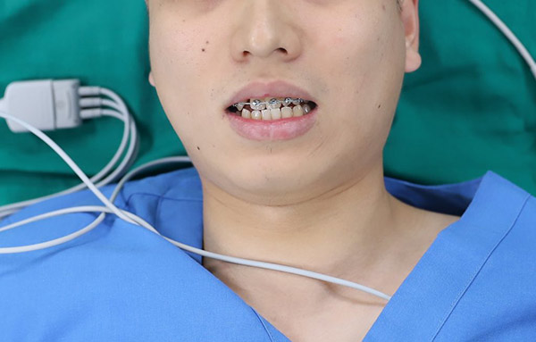 Mặc dù anh Hoàng đã thực hiện niềng răng nhưng vẫn không xử lý được do bị thiếu răng trong thời gian dài nên anh tiếp tục thực hiện cấy xương trồng răng