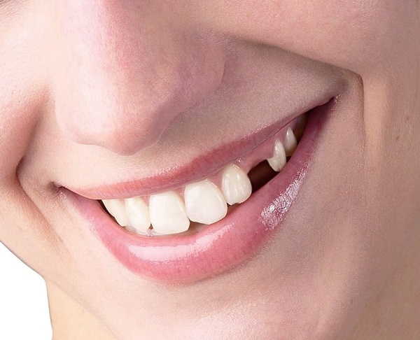 Nang chân răng không điều trị kịp thời có thể dẫn đến mất răng 