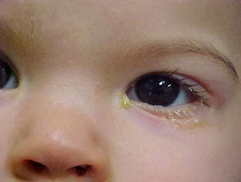 Mắt trẻ sơ sinh bị ghèn