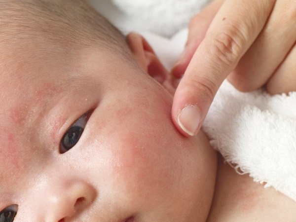 Mụn sữa ở trẻ sơ sinh có gây ngứa không?
