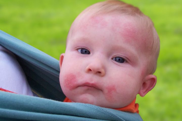 Bệnh nấm da ở trẻ sơ sinh thường xuất hiện ở vùng nào trên cơ thể?
