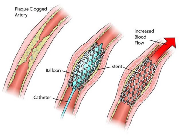 Người đặt stent mạch vành sống được bao lâu