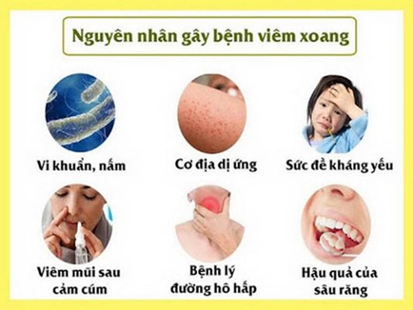 Một số nguyên nhân gây viêm xoang mũi