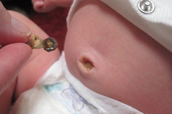 Tình trạng nhiễm trùng có thể là nguyên nhân gây mùi hôi ở rốn trẻ sơ sinh
