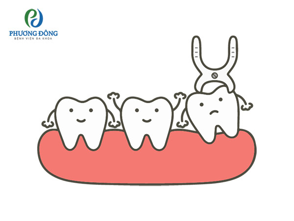 Khi răng khôn mọc lệch gây ra các biến chứng đau, nhiễm trùng... cần phải nhổ răng khôn