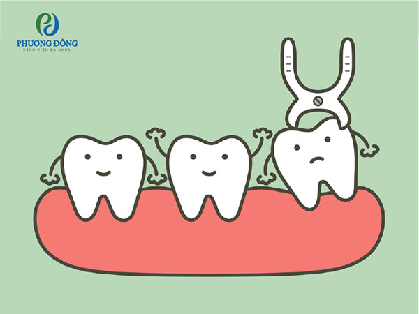 Chi phí nhổ răng khôn có đắt không tùy thuộc và tình trạng răng của mỗi người