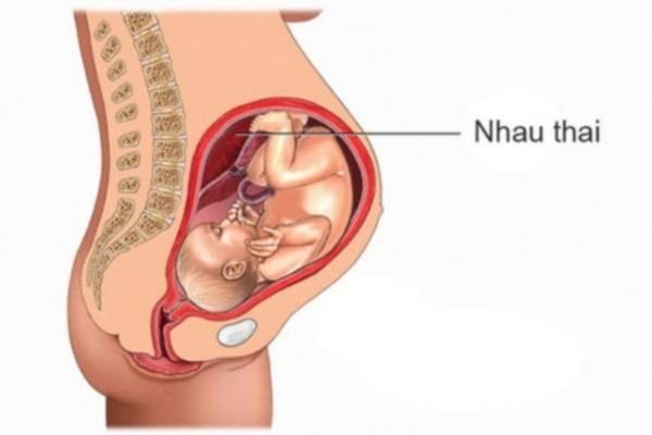 Nhau thai bong non là một trong những nguyên nhân gây ra máu khi mang thai