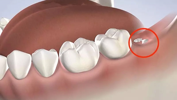 Răng cấm mọc khác biệt ở nam giới và nữ giới không?
