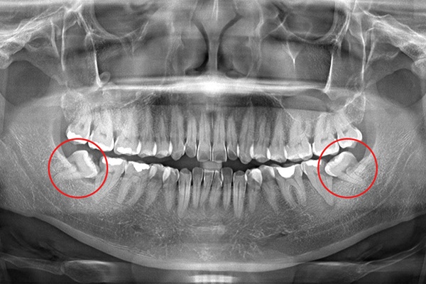 Hình ảnh X-quang 2 răng khôn đang mọc lệch