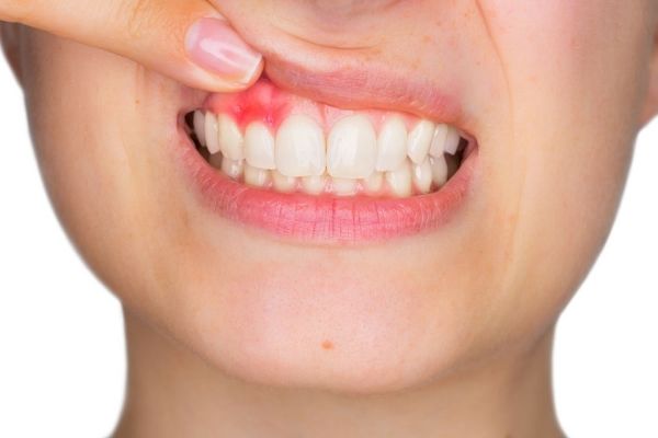 Tình trạng răng khôn mọc lệch có thể gây viêm nướu