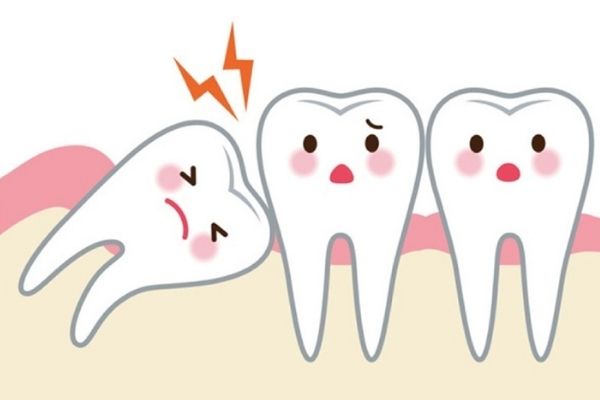 Răng khôn mọc lệch 90 độ gây ra nhiều biến chứng ảnh hưởng tới sức khỏe